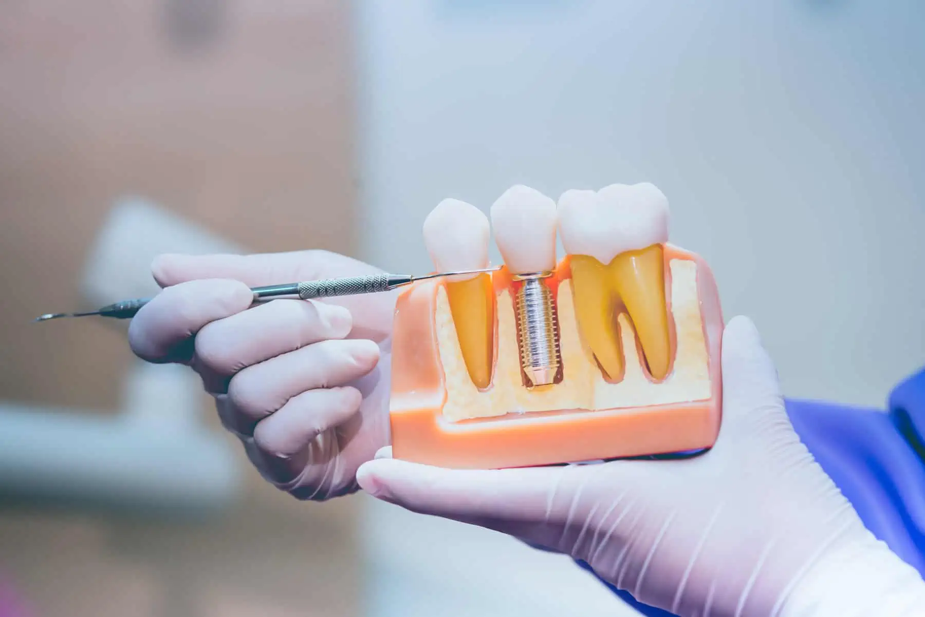 Gloved dentist holding a cross-section model showing a dental implant in the jawbone
